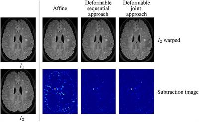 A unified framework for focal intensity change detection and deformable image registration. Application to the monitoring of multiple sclerosis lesions in longitudinal 3D brain MRI